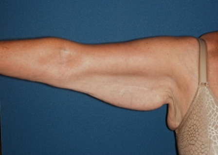 Brachioplasty 1 preop-previously with unsatisfactory result from another surgeon. Brachioplasty 1 preop-previously with unsatisfactory result from another surgeon.
