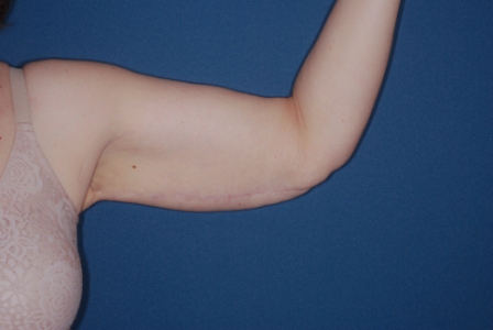 Brachioplasty 2 postop Brachioplasty 2 postop