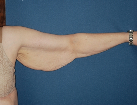 Brachioplasty 2 preop Brachioplasty 2 preop
