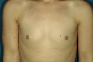 Breast Augmentation 1 Preop Breast Augmentation 1 Preop