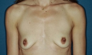 Breast Augmentation 3 Preop Breast Augmentation 3 Preop