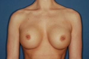 Breast Augmentation 4 Postop Breast Augmentation 4 Postop