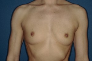 Breast Augmentation 4 Preop Breast Augmentation 4 Preop