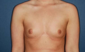 Breast Augmentation 5 Preop Breast Augmentation 5 Preop