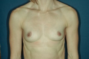 Breast Augmentation 6 Preop Breast Augmentation 6 Preop