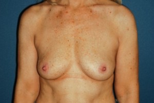 Breast Augmentation 7 Preop Breast Augmentation 7 Preop