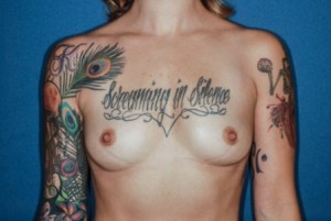Breast Augmentation 8 Preop Breast Augmentation 8 Preop