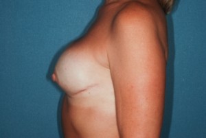 Breast Reconstrucion 1 postop lateral Breast Reconstrucion 1 postop lateral