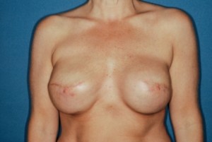 Breast Reconstruction 2 postop 2 stage reconstrucion with gel implants and nipple reconstrucion