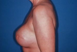 Breast Reconstruction 2 postop lateral Breast Reconstruction 2 postop lateral