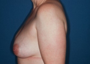 Breast Reconstruction 2 preop lateral