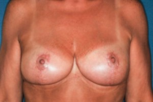 Breast Reduction 2 postop - Lubbock Plastic Surgery Breast Reduction 2 postop - Lubbock Plastic Surgery