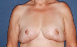 Breast Reduction 3 post lateral - Lubbock Plastic Surgery Breast Reduction 3 post lateral - Lubbock Plastic Surgery