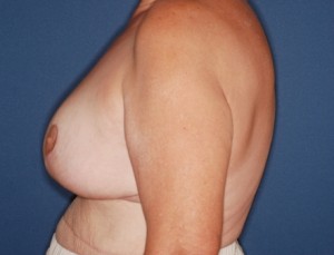 Breast Reduction 3 postop lateral - Lubbock Plastic Surgery Breast Reduction 3 postop lateral - Lubbock Plastic Surgery