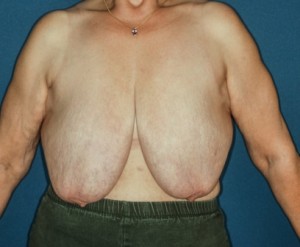 Breast Reduction 3 preop lateral - Lubbock Plastic Surgery Breast Reduction 3 preop lateral - Lubbock Plastic Surgery