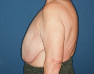 Breast Reduction 3 preop lateral - Lubbock Plastic Surgery Breast Reduction 3 preop lateral - Lubbock Plastic Surgery
