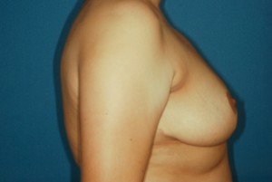 Breast Reduction 4 postop lateral - Lubbock Plastic Surgery Breast Reduction 4 postop lateral - Lubbock Plastic Surgery