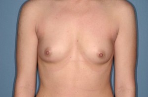 Breast Augmentation 12 Preop Breast Augmentation 12 Preop