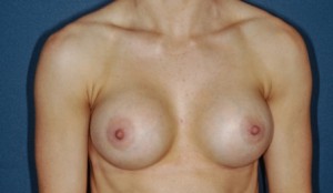Breast Augmentation 6 Postop Breast Augmentation 6 Postop