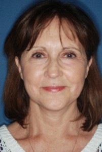 Facelift 1 postop - Lubbock Plastic Surgery Facelift 1 postop - Lubbock Plastic Surgery
