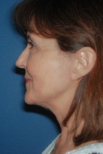 Facelift 1 postop lateral - Lubbock Plastic Surgery Facelift 1 postop lateral - Lubbock Plastic Surgery