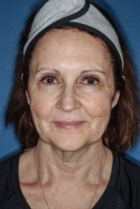 Facelift 1 preop - Lubbock Plastic Surgery Facelift 1 preop - Lubbock Plastic Surgery