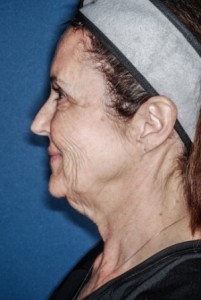 Facelift 1 preop lateral - Lubbock Plastic Surgery Facelift 1 preop lateral - Lubbock Plastic Surgery