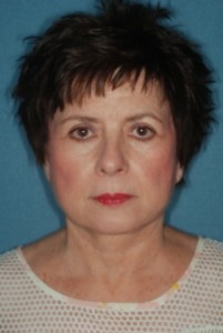 Facelift 2 postop -Lubbock Plastic Surgery Facelift 2 postop -Lubbock Plastic Surgery
