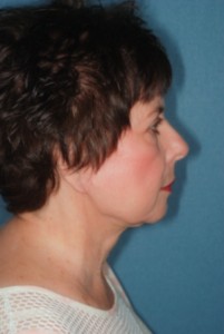 Facelift 2 postop lateral -Lubbock Plastic Surgery Facelift 2 postop lateral -Lubbock Plastic Surgery