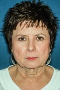 Facelift 2 preop -Lubbock Plastic Surgery Facelift 2 preop -Lubbock Plastic Surgery