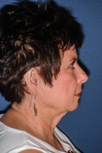 Facelift 2 preop lateral -Lubbock Plastic Surgery Facelift 2 preop lateral -Lubbock Plastic Surgery