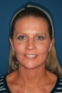 Facelift 3 postop -Lubbock Plastic Surgery Facelift 3 postop -Lubbock Plastic Surgery
