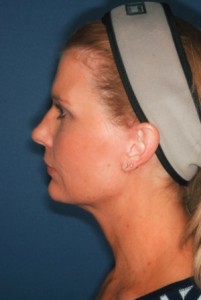 Facelift 3 postop lateral -Lubbock Plastic Surgery Facelift 3 postop lateral -Lubbock Plastic Surgery