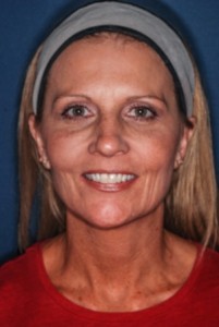 Facelift 3 preop -Lubbock Plastic Surgery Facelift 3 preop -Lubbock Plastic Surgery