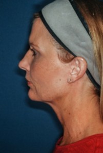 Facelift 3 preop lateral -Lubbock Plastic Surgery Facelift 3 preop lateral -Lubbock Plastic Surgery