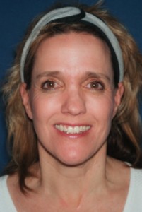Facelift 4 postop 2 weeks -Lubbock Plastic Surgery Facelift 4 postop 2 weeks -Lubbock Plastic Surgery