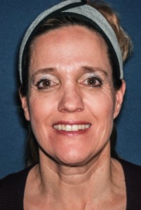 Facelift 4 preop -Lubbock Plastic Surgery Facelift 4 preop -Lubbock Plastic Surgery