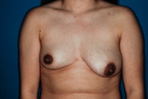 Mastopexy 1, with implant and asymmetry preop