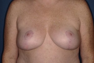 Mastopexy 2 postop Mastopexy 2 postop - - Lubbock Plastic Surgery