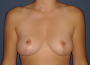 Mastopexy 4, correction of asymmetry postop Mastopexy 4, correction of asymmetry postop - Lubbock Plastic Surgery