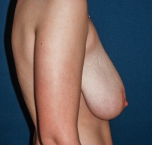Mastopexy 4 preop lateral Mastopexy 4 preop lateral - Lubbock Plastic Surgery