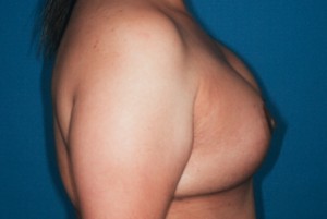 Mastopexy 5 postop lateral Mastopexy 5 postop lateral - Lubbock Plastic Surgery