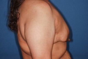 Mastopexy 5 preop lateral Mastopexy 5 preop lateral - Lubbock Plastic Surgery