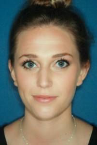 Otoplasty 1 postop Otoplasty 1 postop