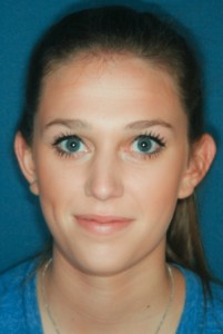 Otoplasty 1 preop Otoplasty 1 preop