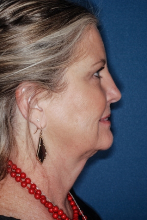 Submental liposuction 1 postop lateral Submental liposuction 1 postop lateral