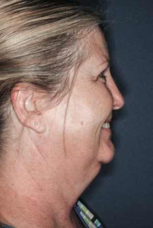 Submental liposuction 1 preop lateral Submental liposuction 1 preop lateral
