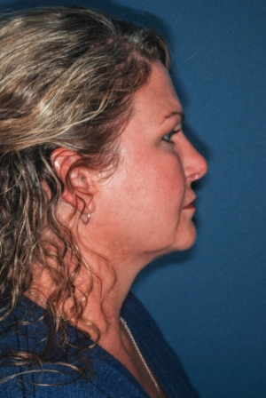 Submental liposuction 2 postop lateral Submental liposuction 2 postop lateral