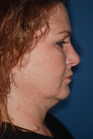 Submental liposuction 2 preop lateral Submental liposuction 2 preop lateral