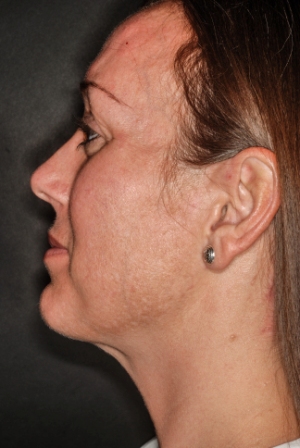 Submental liposuction 3 postop lateral Submental liposuction 3 postop lateral